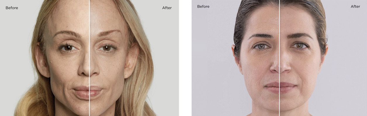 before and after sculptra photos